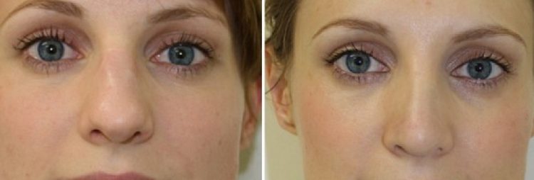 фото до и после уменьшения носа