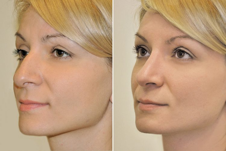 девушка на фото до и после, нос меньше