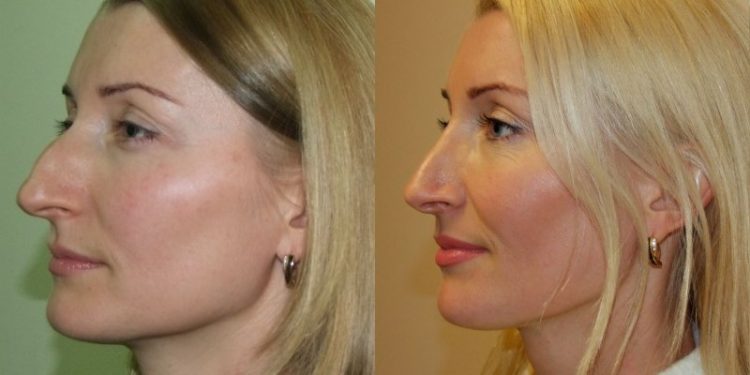 блондинка в профиль до и после операции на нос