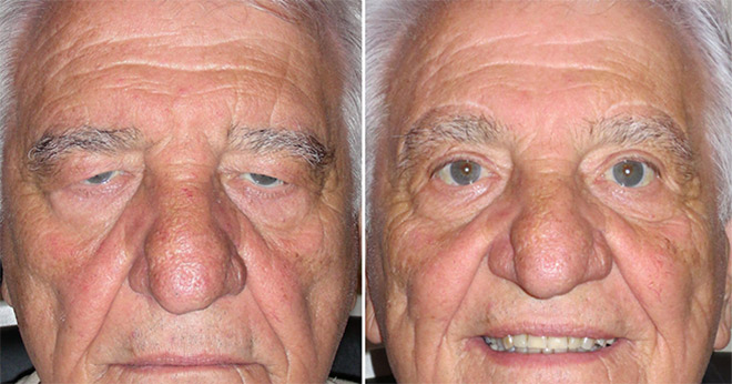 фото до и после блефаропластики пожилого мужчины