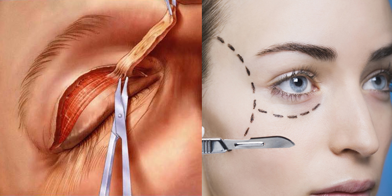 картинка проведения операции и пунктир на лице