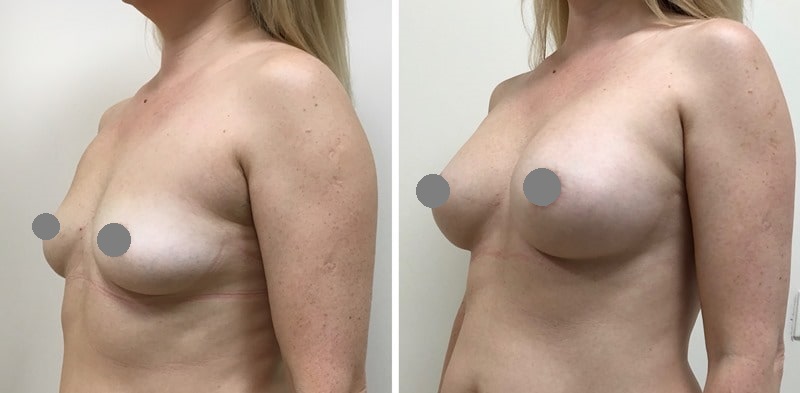 пластика груди: до и после