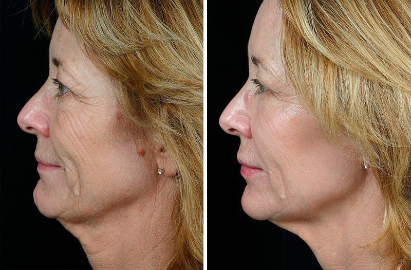 Термаж лица: фото до и после
