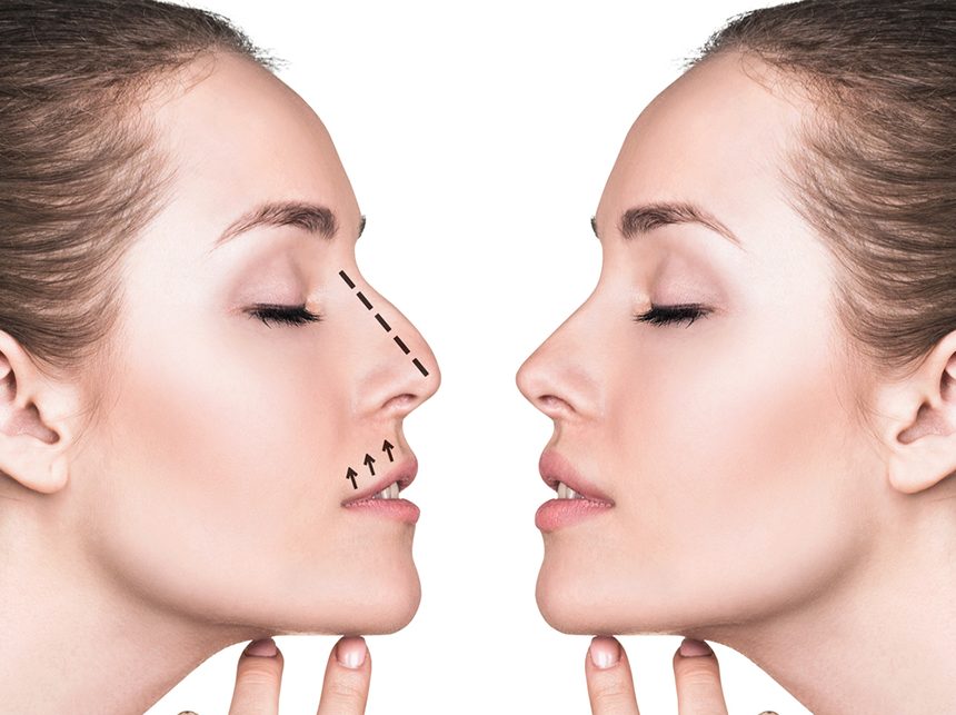 ринопластика девушки друг напротив друга с пунктиром на носу