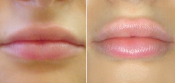 фото до и после увеличения губ
