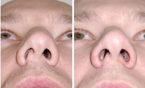 операция по исправлению носовой перегородки фото до и после