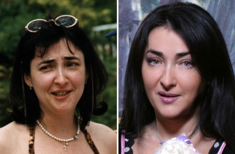 Лолита на фото до и после пластики лица
