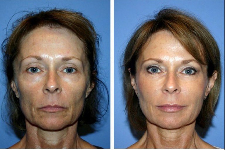 Фото до и после липофилинга лица 