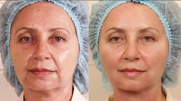 Фото до и после армирования лица
