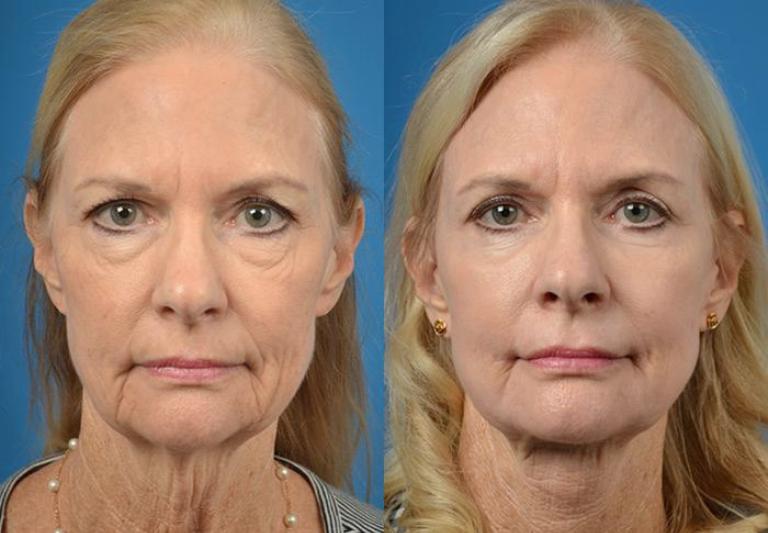 Фото до и после термолифтинга лица