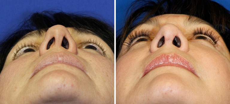 Септопластика носа: фото до и после 