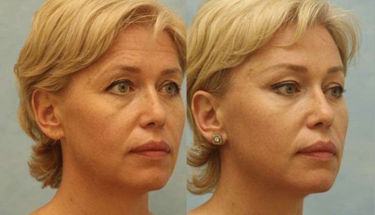 До и после эндоскопической подтяжки лица 