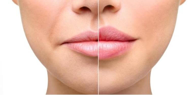 Увеличение губ гиалуроновой кислотой 