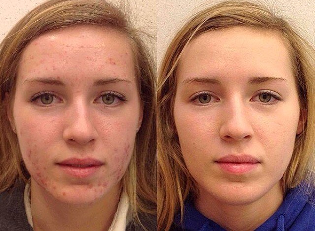 Демодекс на лице фото до и после