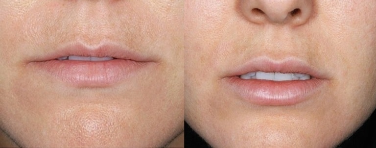 Липофилинг губ фото до и после