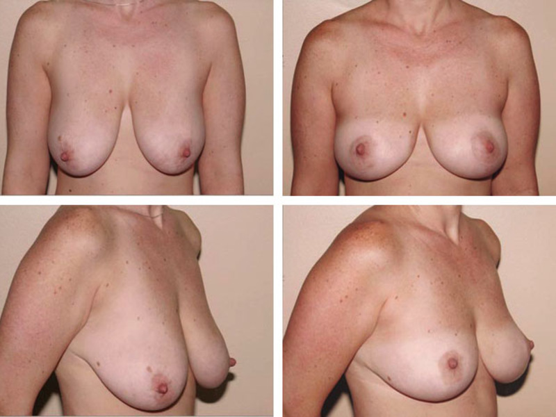 Подтяжка грудных желез фото до и после