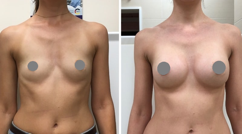до и после пластики груди