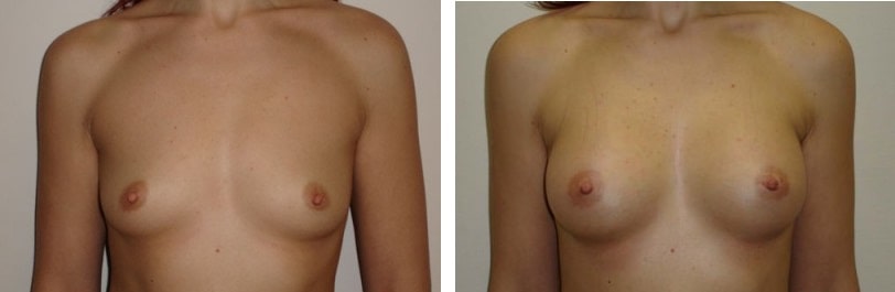 до и после увеличения груди 