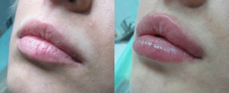 Фото до и после контурной пластики губ 