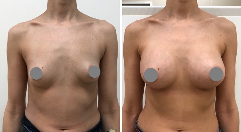 пластика груди: фото до и после