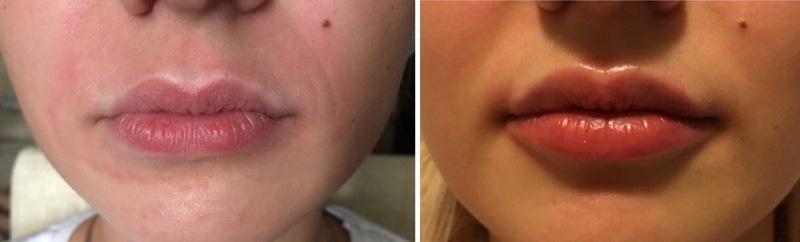 Биоревитализация губ: фото до и после