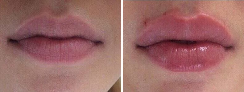 Увеличение губ филлерами до и после 
