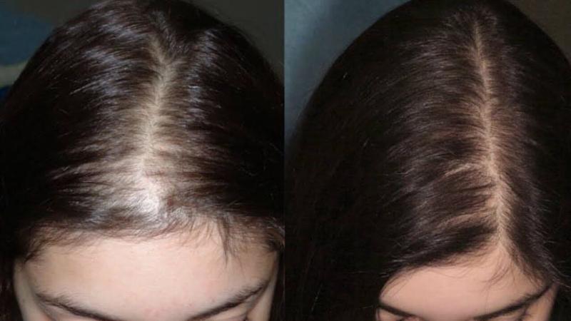 Криомассаж головы: фото до и после 