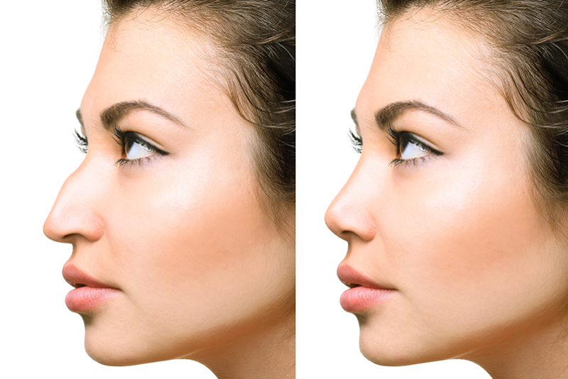 Фото до и после операции носа