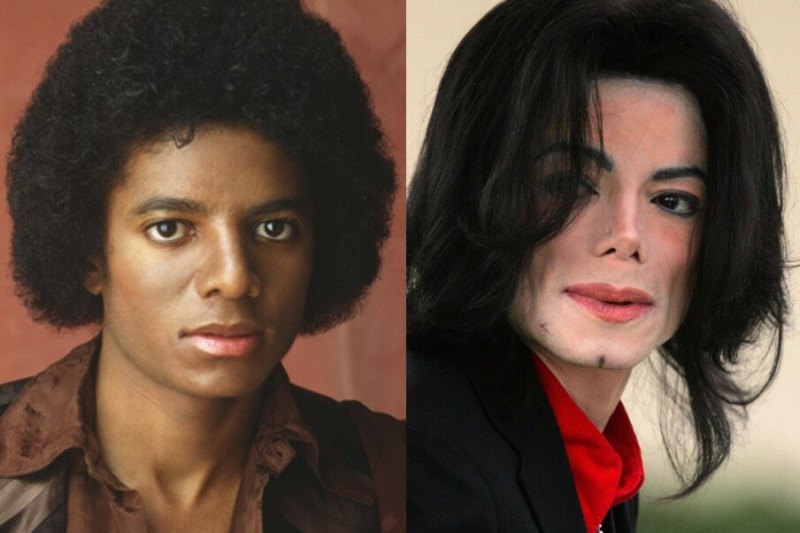 Неудачная ринопластика Майкла Джексона