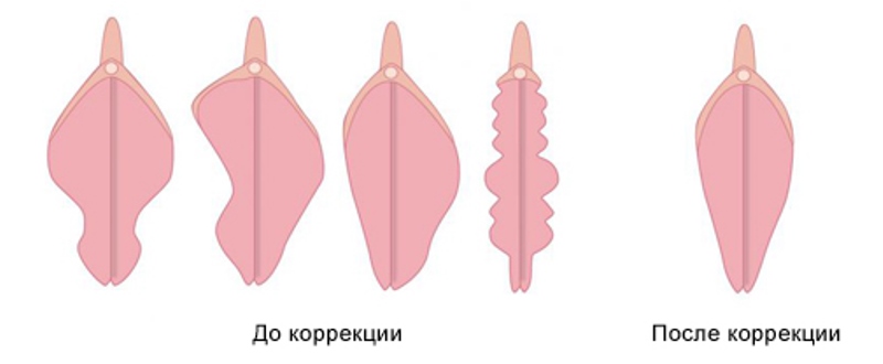 Уменьшение половых губ: схема