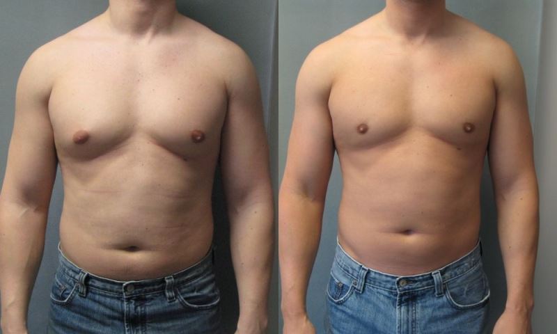 Гинекомастия у мужчин: фото до и после 