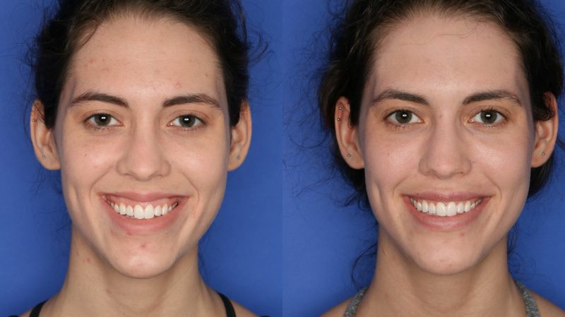Ботокс губ: фото до и после 