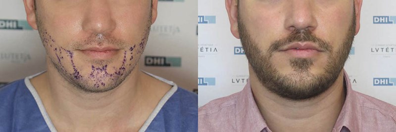 Пересадка бороды: фото до и после 
